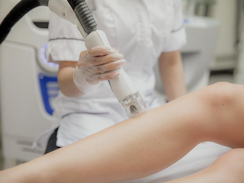 Laser Hair Removal Treatment on Legs