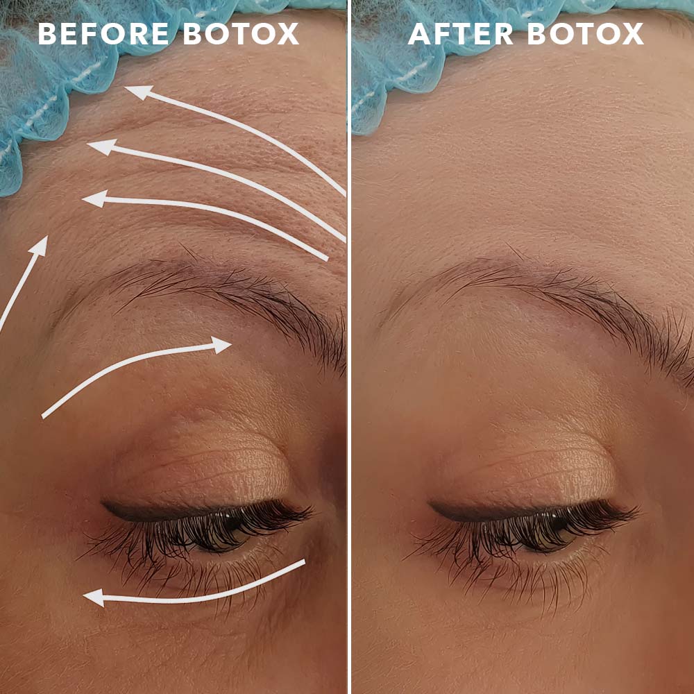 Botox Injections Wirral Before and After