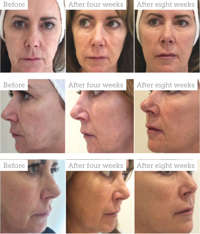 Profhilo Before-After Treatment