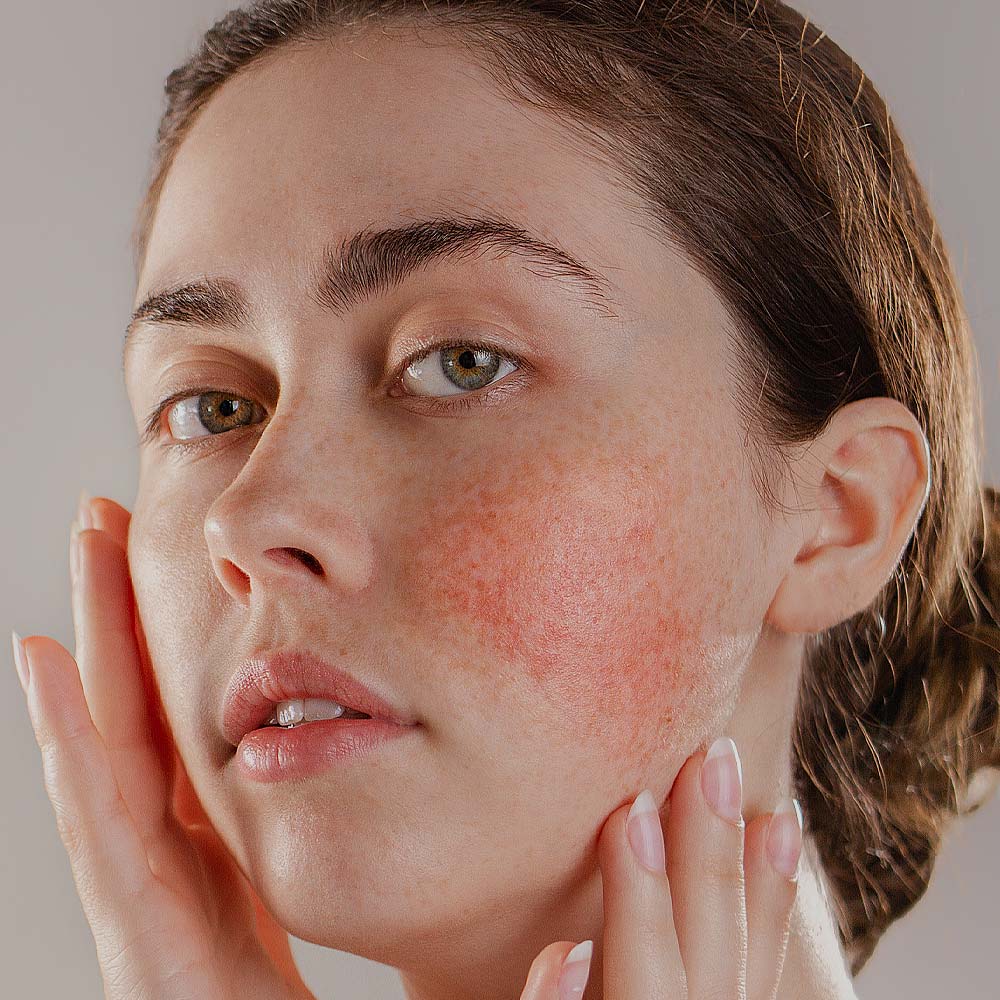Rosacea Treatments Wirral