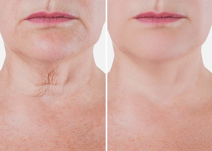 Fibroblast Wirral - Before and After Treatment