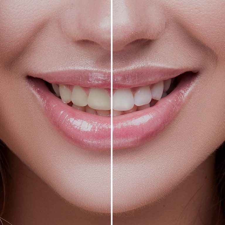 Laser Teeth Whitening Heswall Laser Clinic