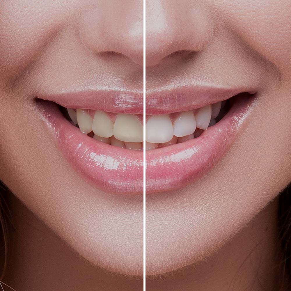 Teeth Whitening Before and After Wirral