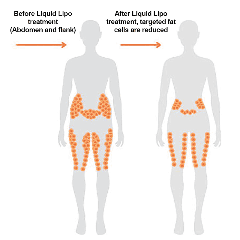 Liquid Lipo Fat Reduction